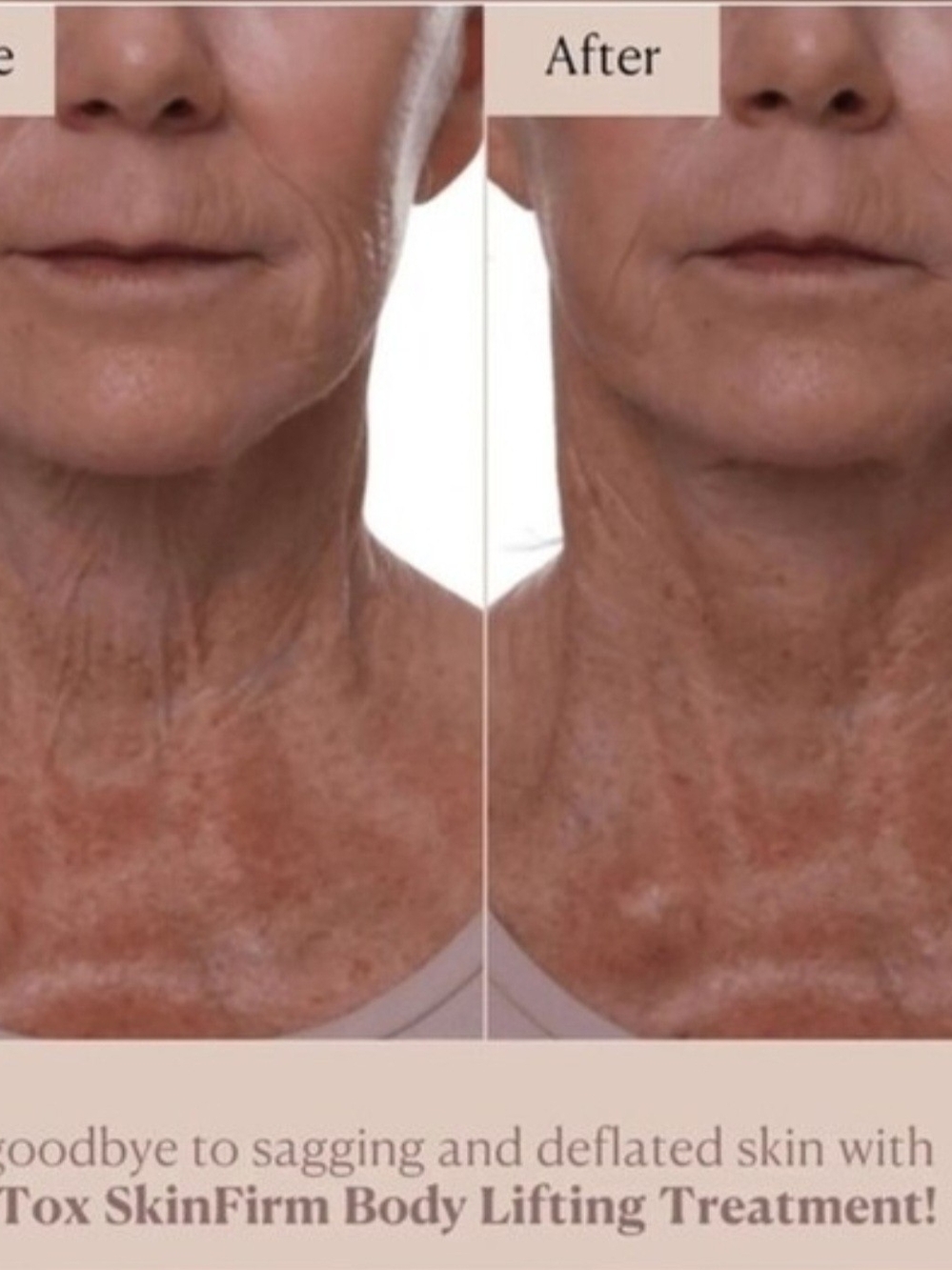 Lift Tox - Picture 4 of 7